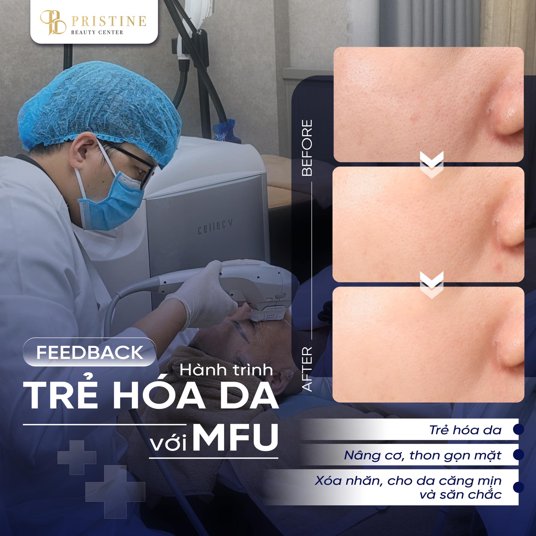 MFU Ultraformer MPT FullFace - Trẻ hóa da toàn diện