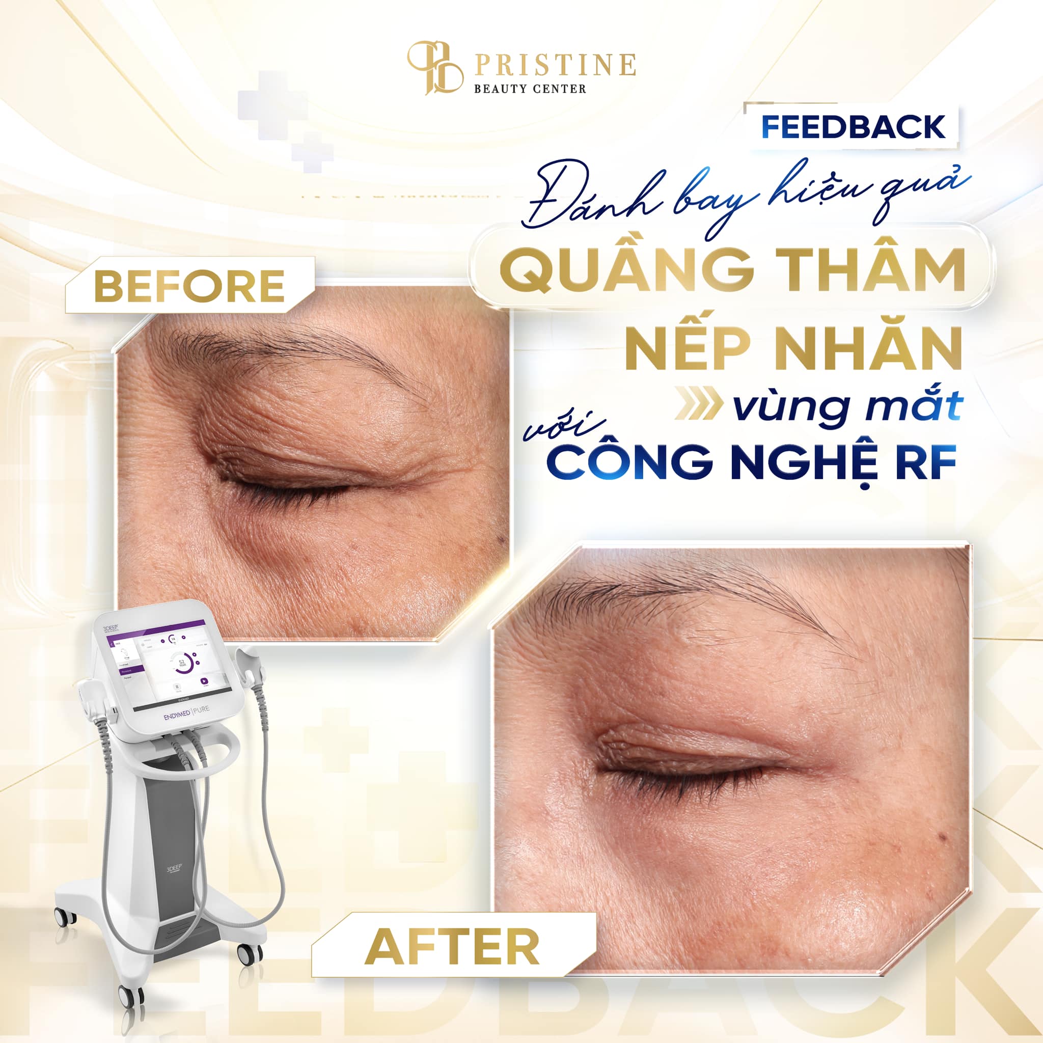RF Quanh mắt - Xóa nhăn, giảm thâm mắt