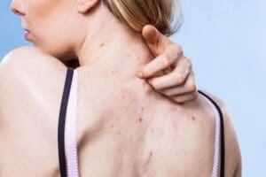 Cách trị mụn lưng tại nhà giúp làn da mềm mịn, sạch mụn, hết thâm