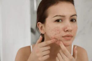 Mụn trứng cá có nên nặn? Cách trị mụn trứng cá nhanh nhất