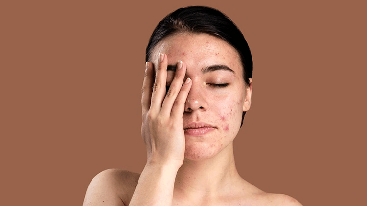Quy trình chăm sóc da mụn đúng cách tại nhà
