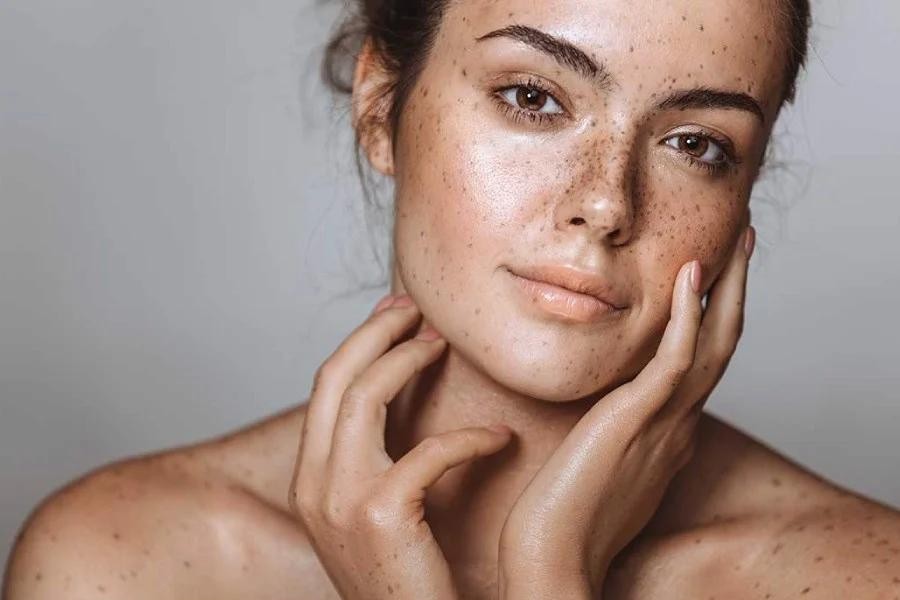 Chia sẻ kinh nghiệm điều trị bớt Hori (nám chân sâu)
