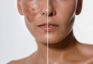 Điều trị đốm nâu trên má: Tạm biệt đốm nâu sau 1 liệu trình