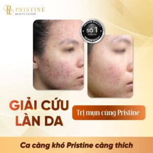 Điều trị mụn hiệu quả nhất ở đâu tại Biên Hòa