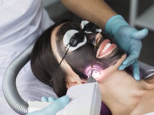 Carbon Peel Laser là gì?