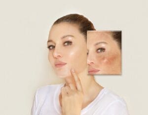 4 Nguyên Nhân phổ biến Gây Nám Da Và Các Biện Pháp Cải Thiện
