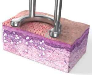 Trẻ hóa da bằng Laser Fractional có đáng sợ như lời đồn?