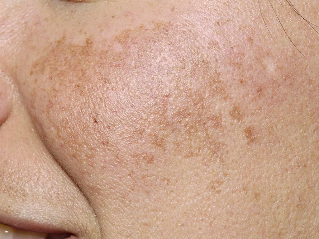 Nám má có phải là bệnh hay không?