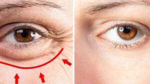 Bí quyết trị bọng mắt dưới giúp hồi sinh nét đẹp rạng rỡ