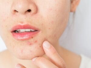 Cách trị mụn quanh miệng và cằm hiệu quả tại nhà
