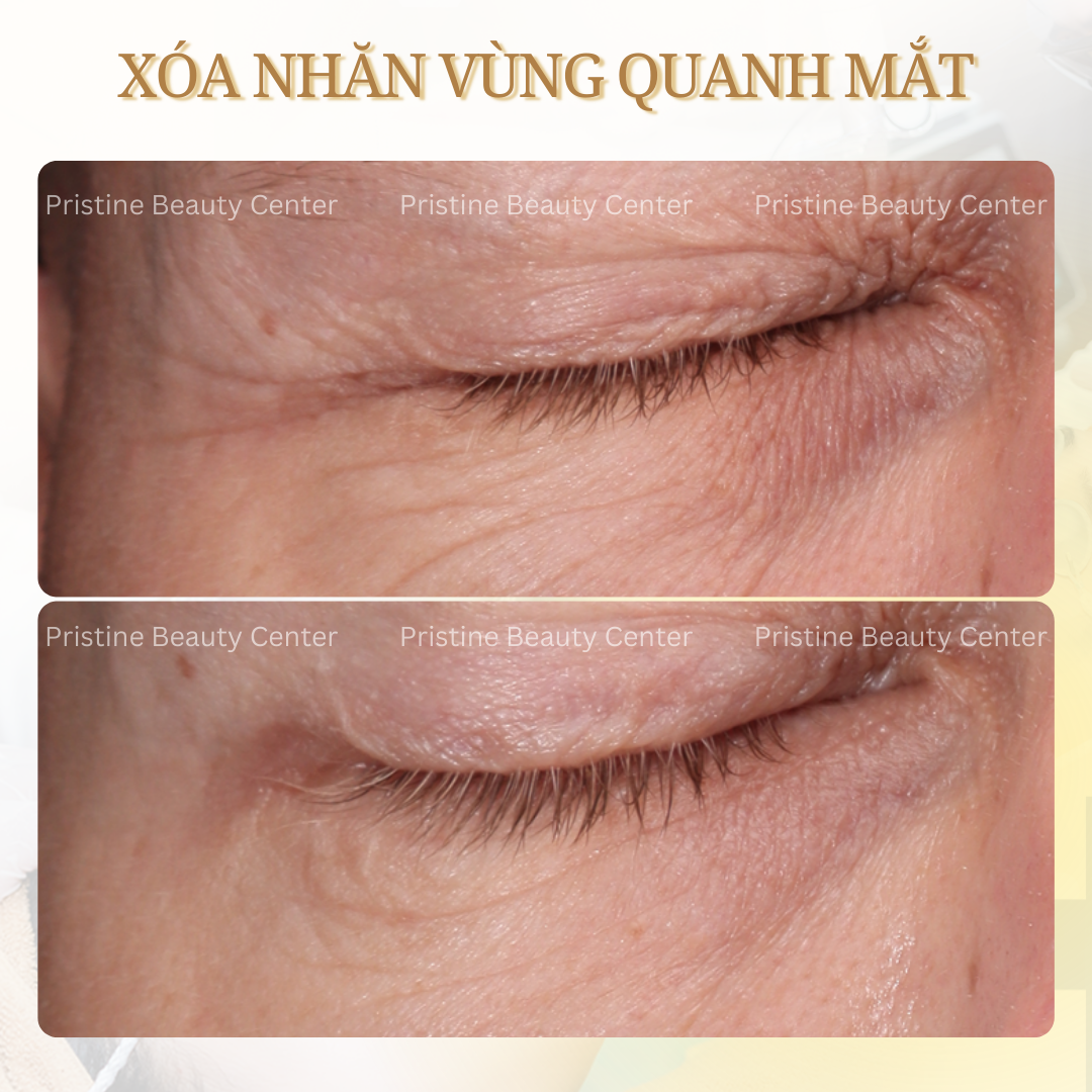 Thon gọn khuôn mặt