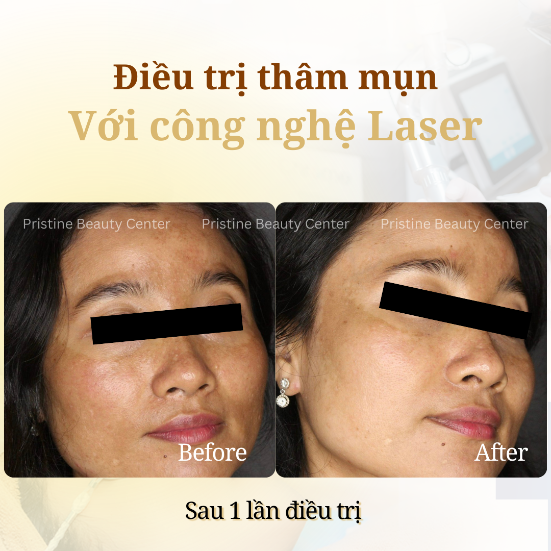 Điều trị Thâm