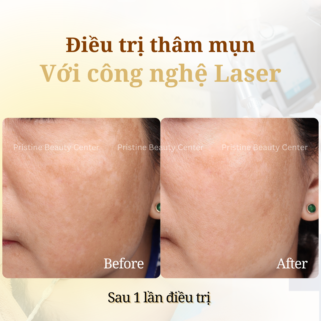 Điều trị Thâm