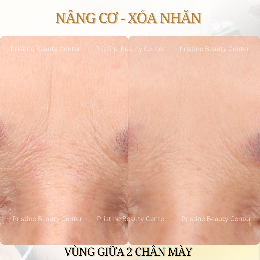 Thon gọn khuôn mặt
