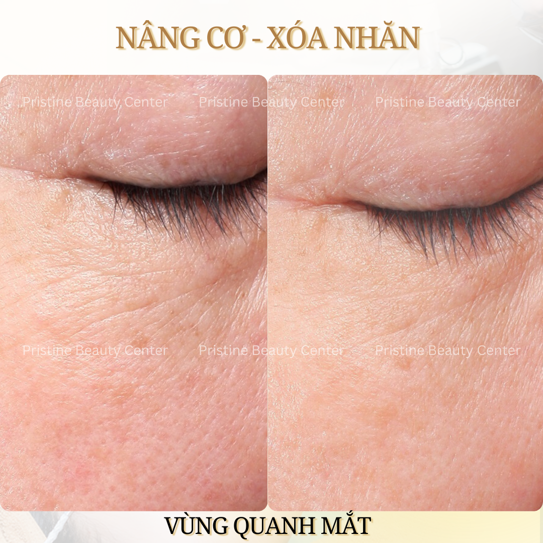 Thon gọn khuôn mặt