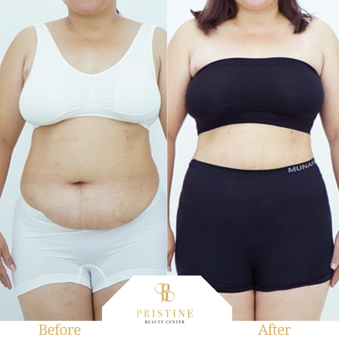 giam-mo-Emsculpt