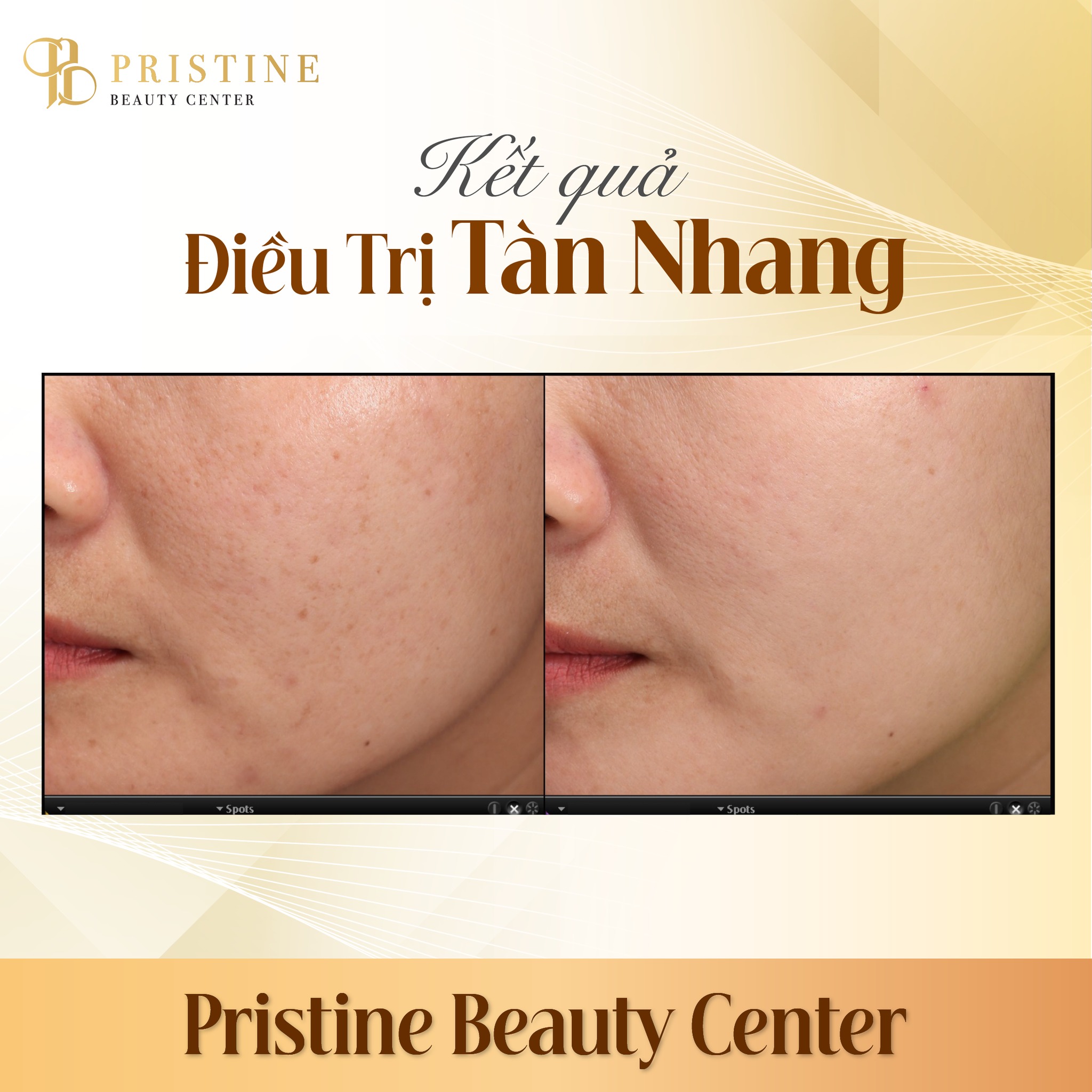 Điều trị Nám/tàn nhang