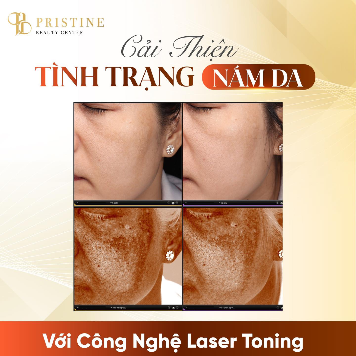 Điều trị Nám/tàn nhang