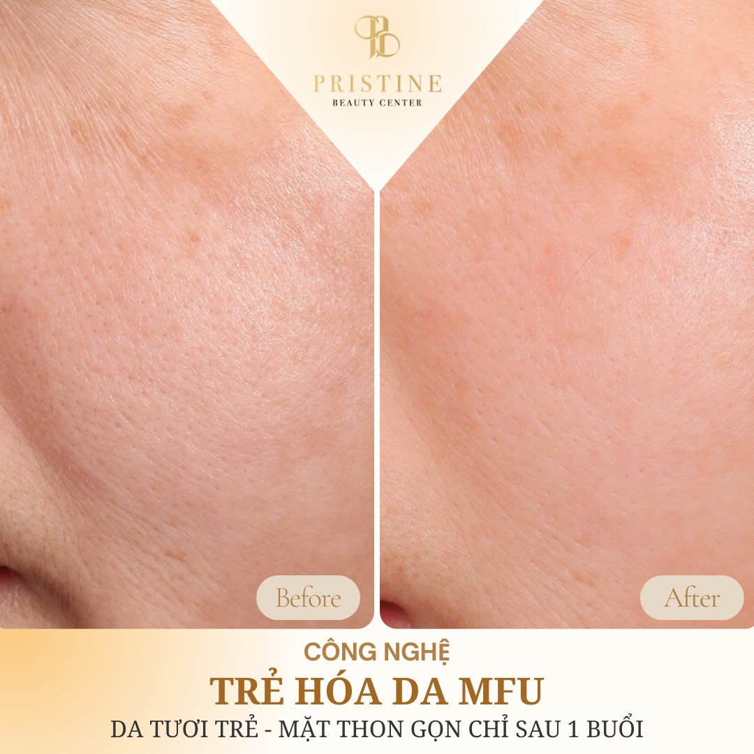 Trẻ hóa da