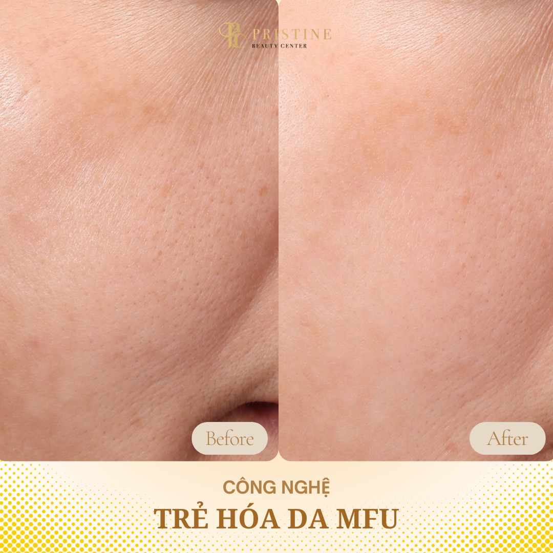 Trẻ hóa da