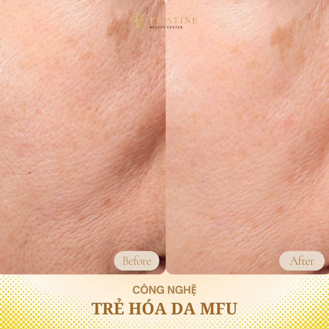 Trẻ hóa da