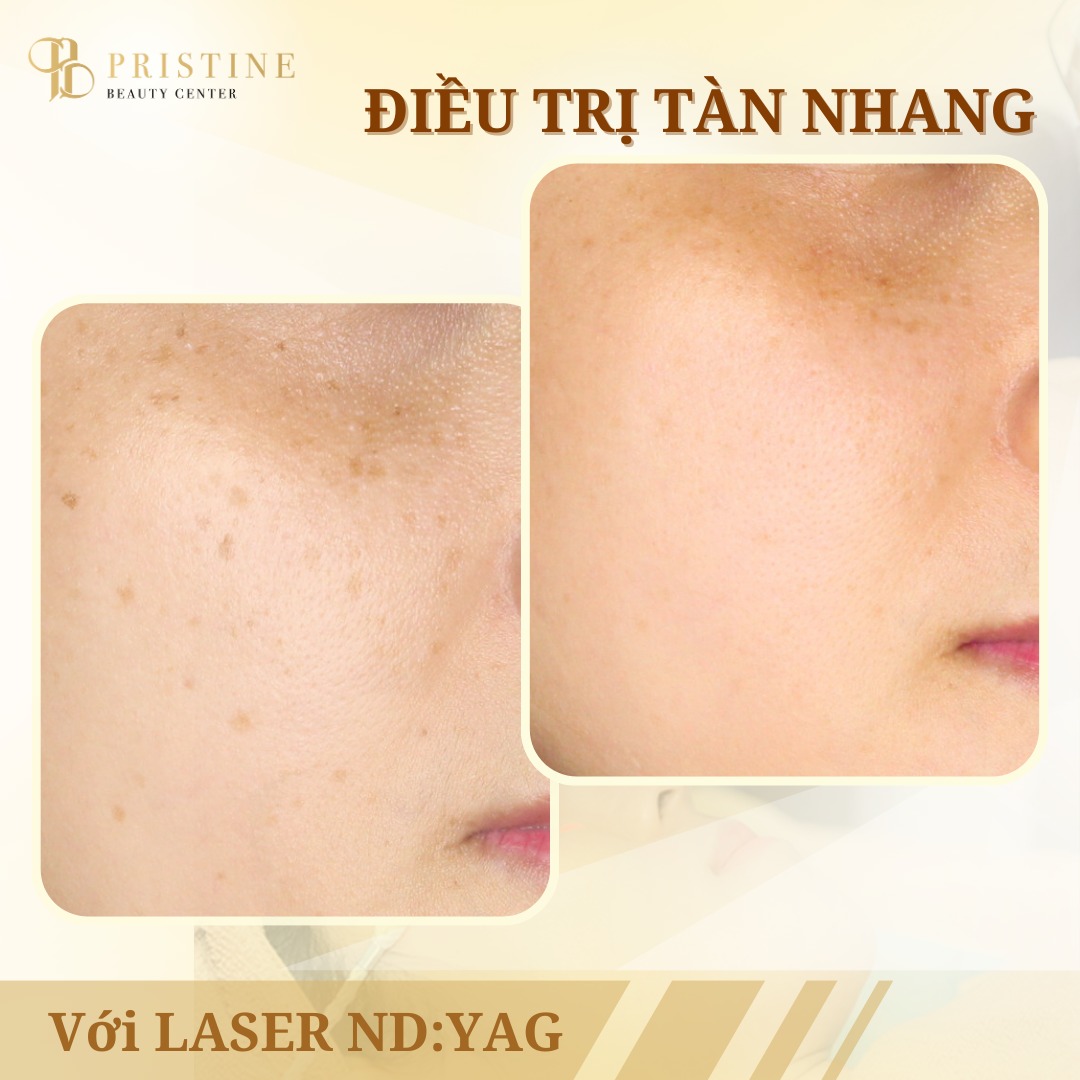 Điều trị Nám/tàn nhang