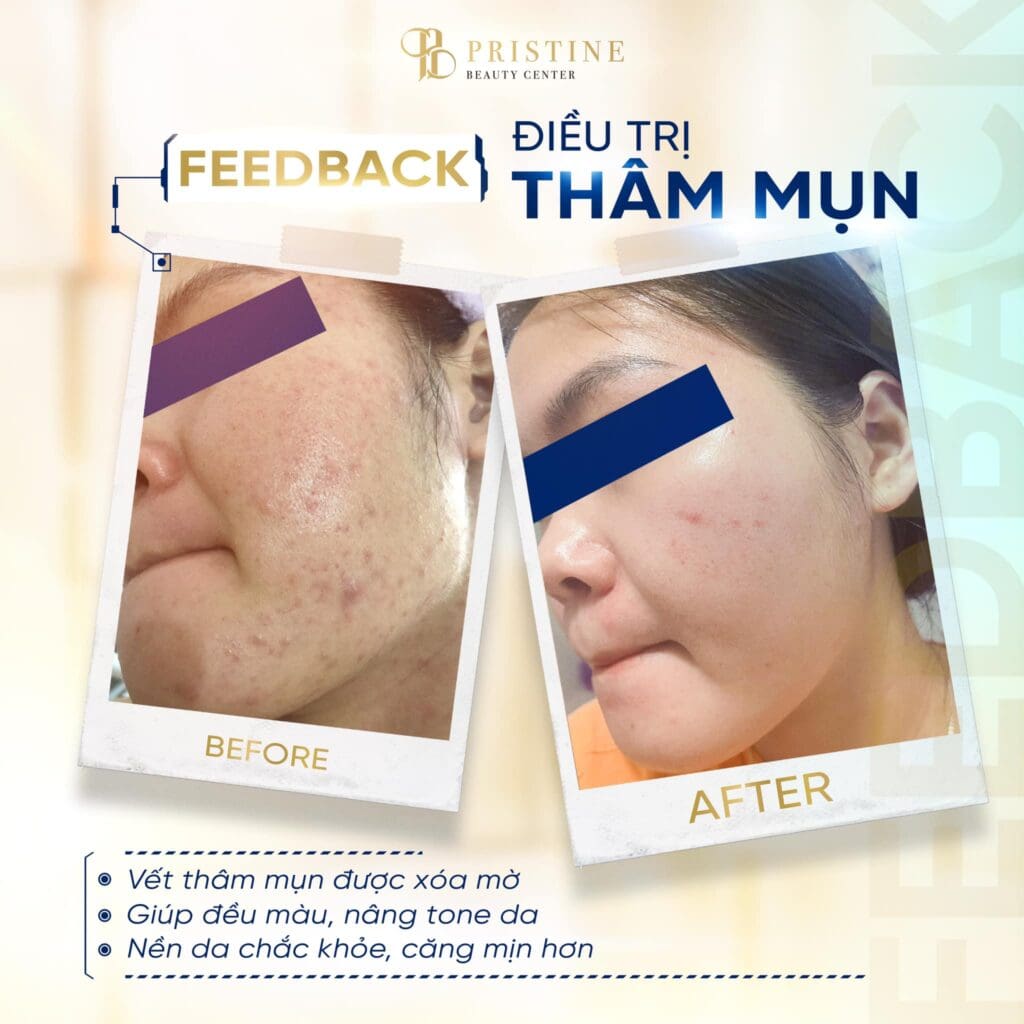 Điều trị Thâm