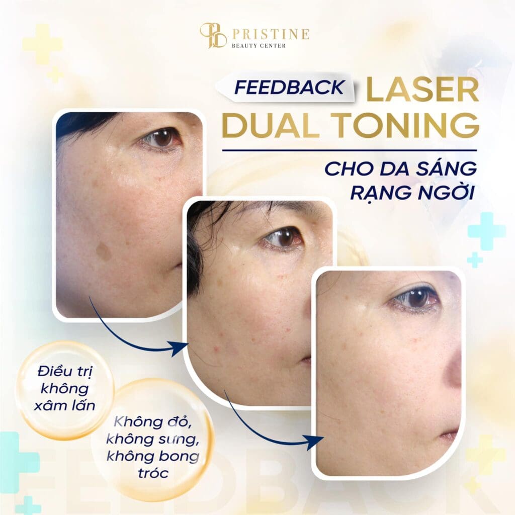 Điều trị Nám/tàn nhang