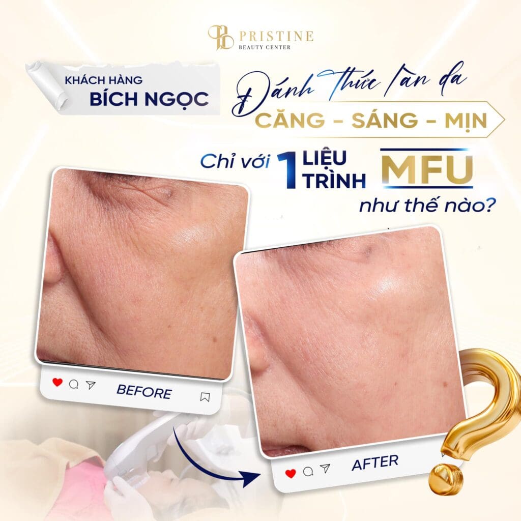 Thon gọn khuôn mặt