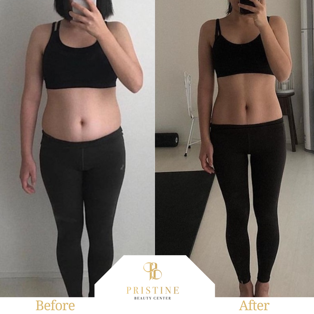 giam-mo-Emsculpt
