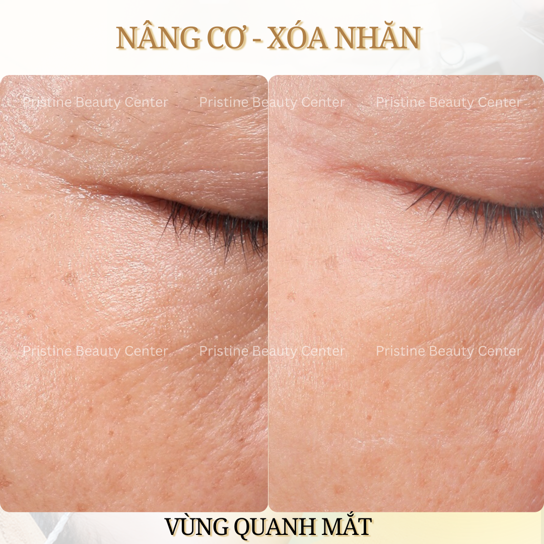 Thon gọn khuôn mặt