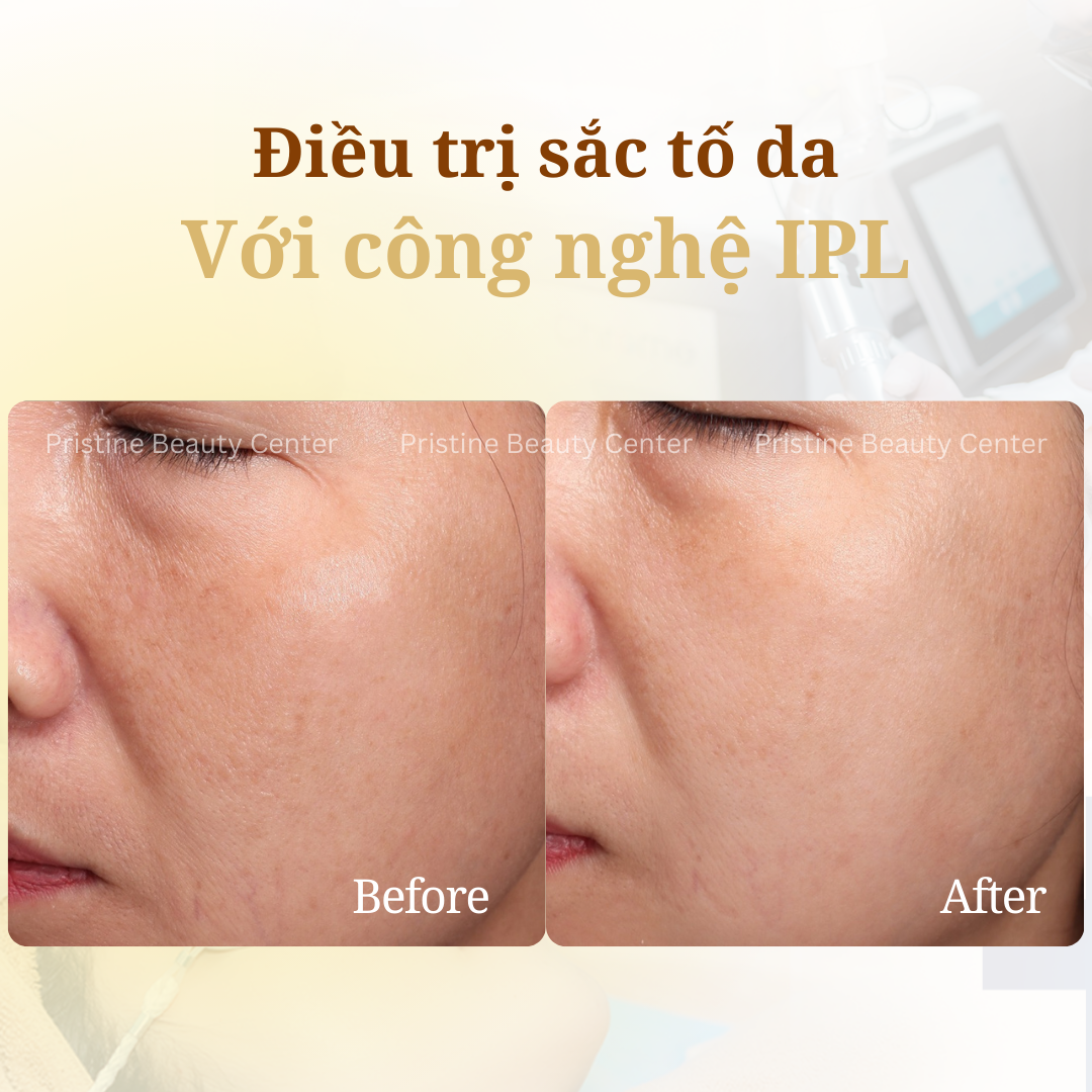 Điều trị Thâm