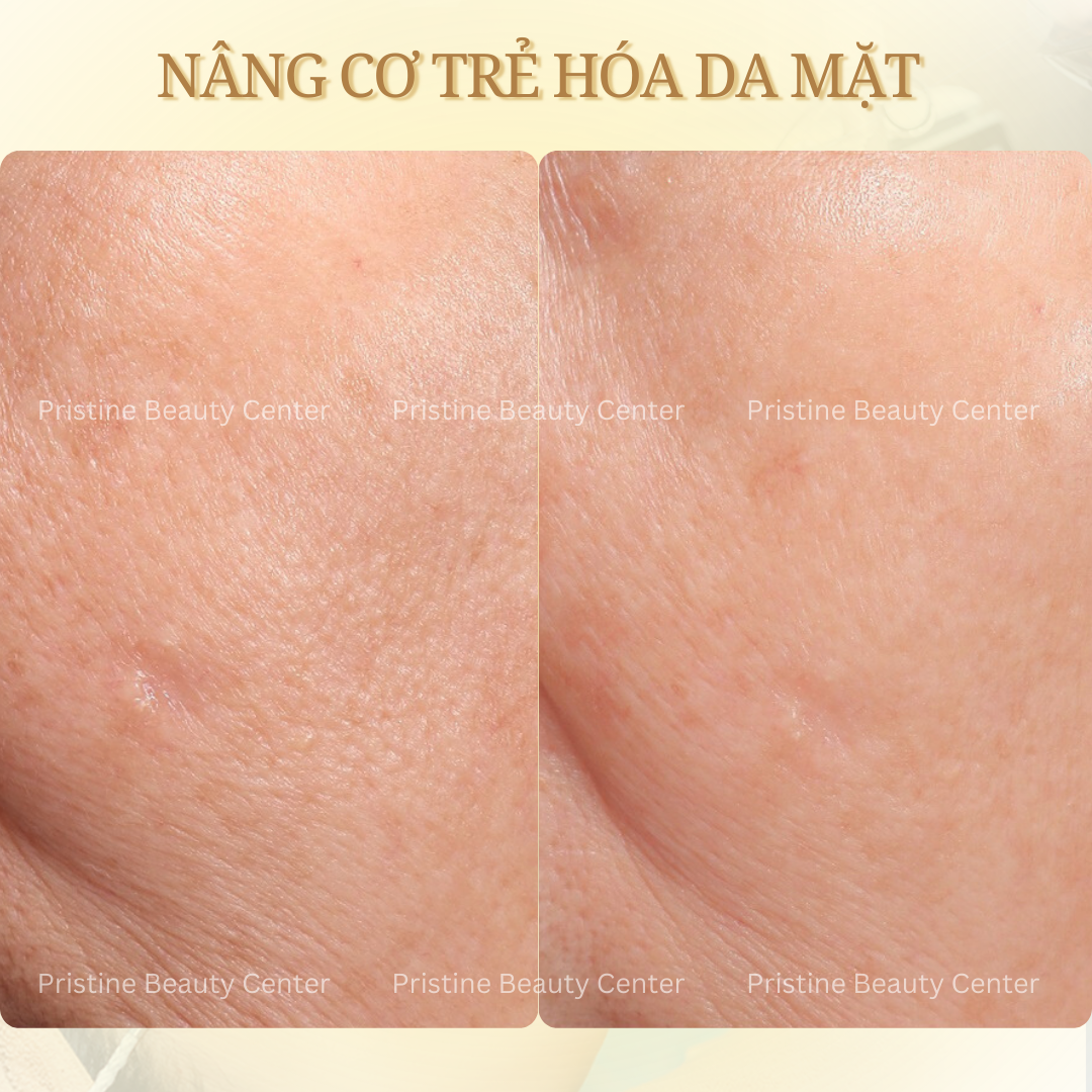 Thon gọn khuôn mặt