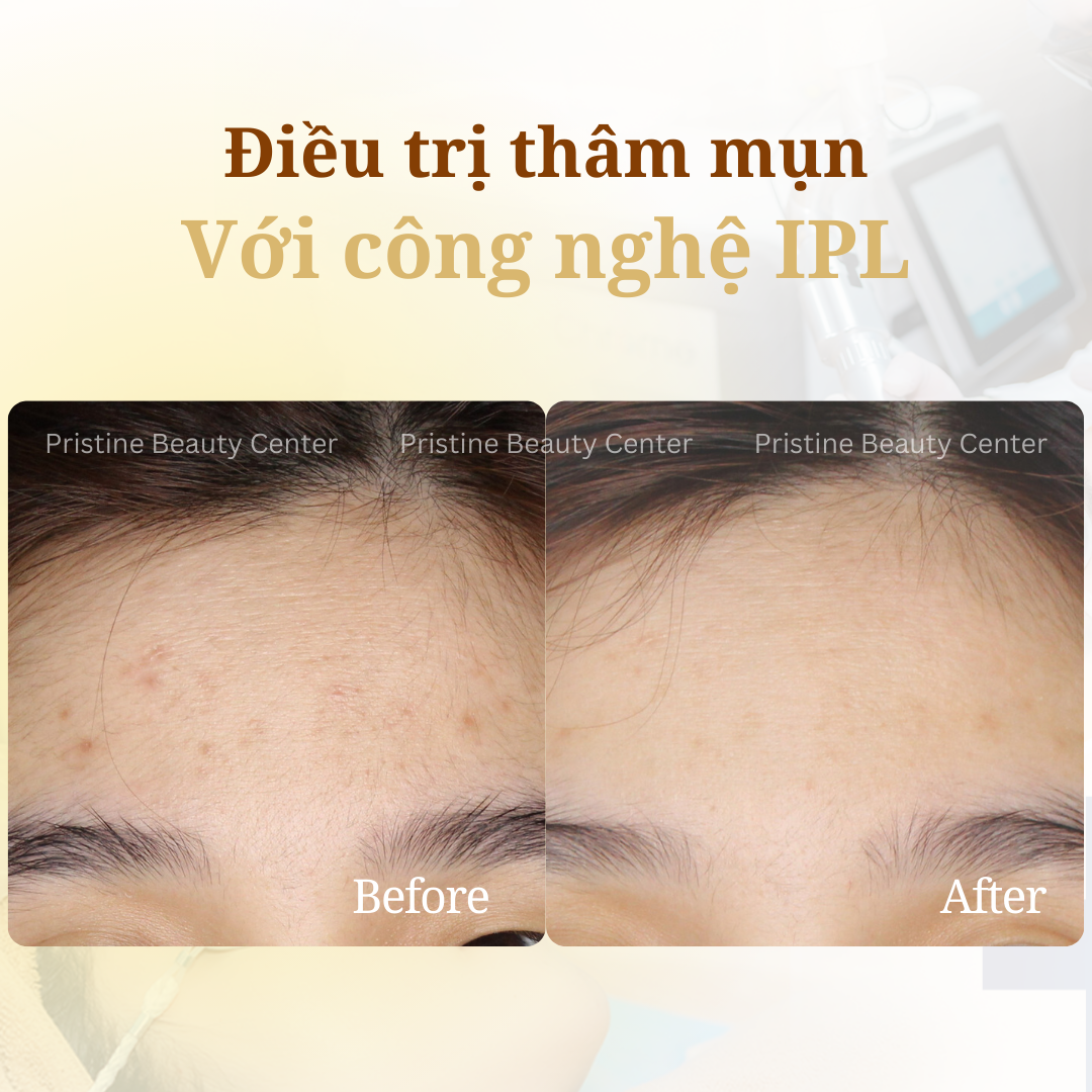 Điều trị Thâm