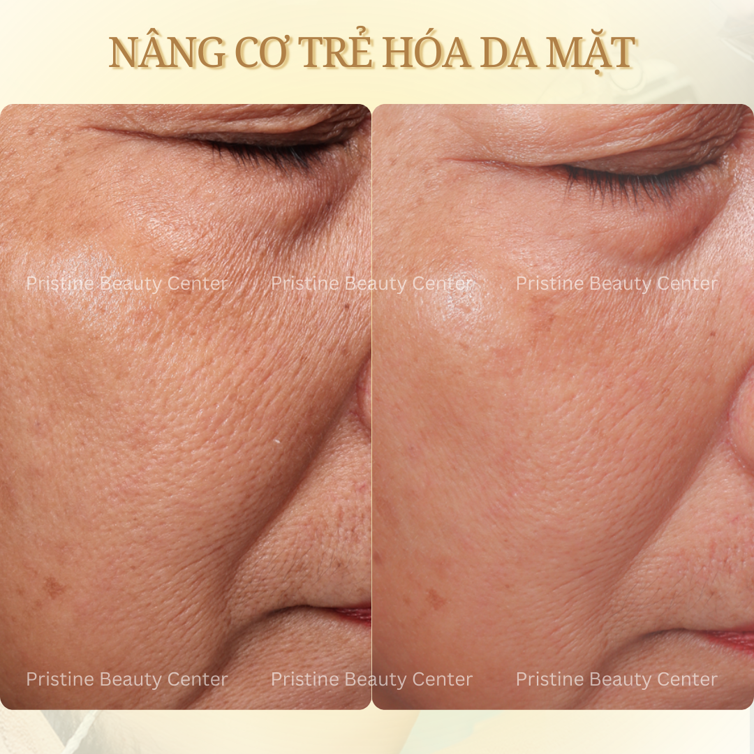 nang-co-xoa-nhan-pristine