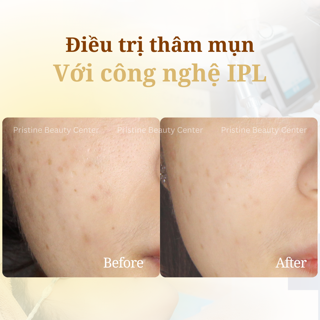 Điều trị Thâm