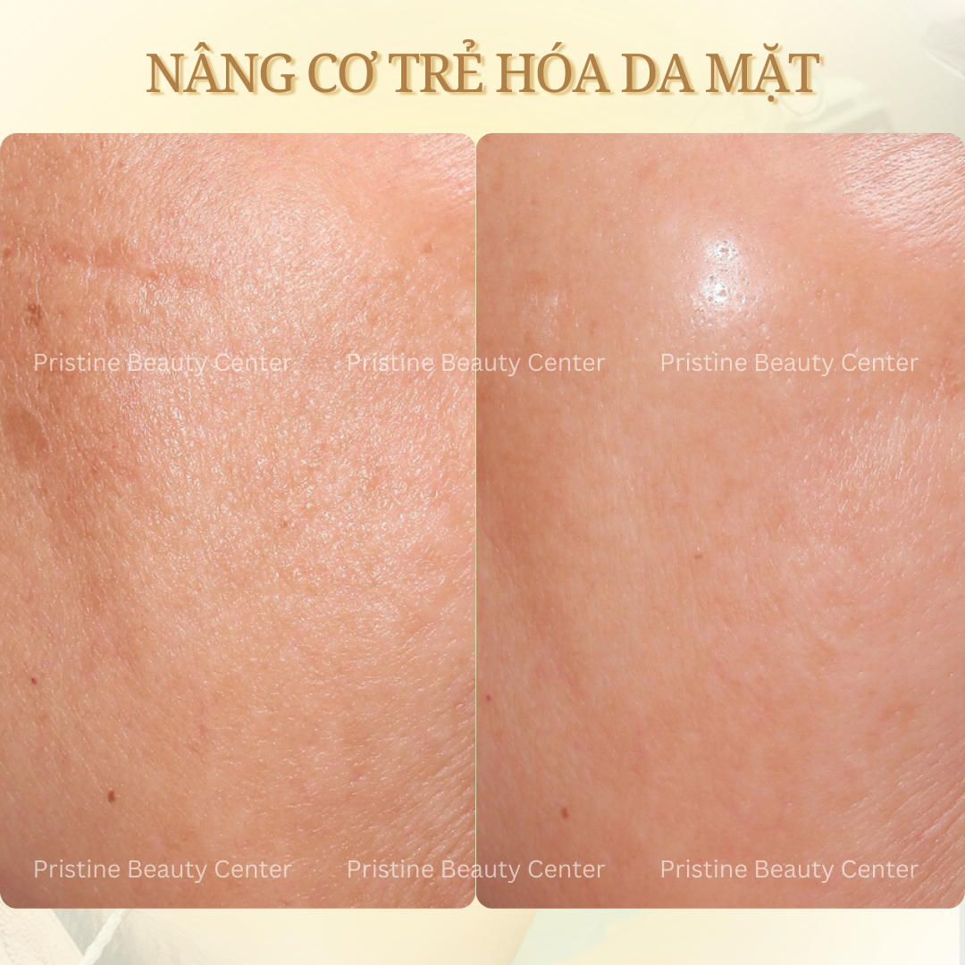 Thon gọn khuôn mặt