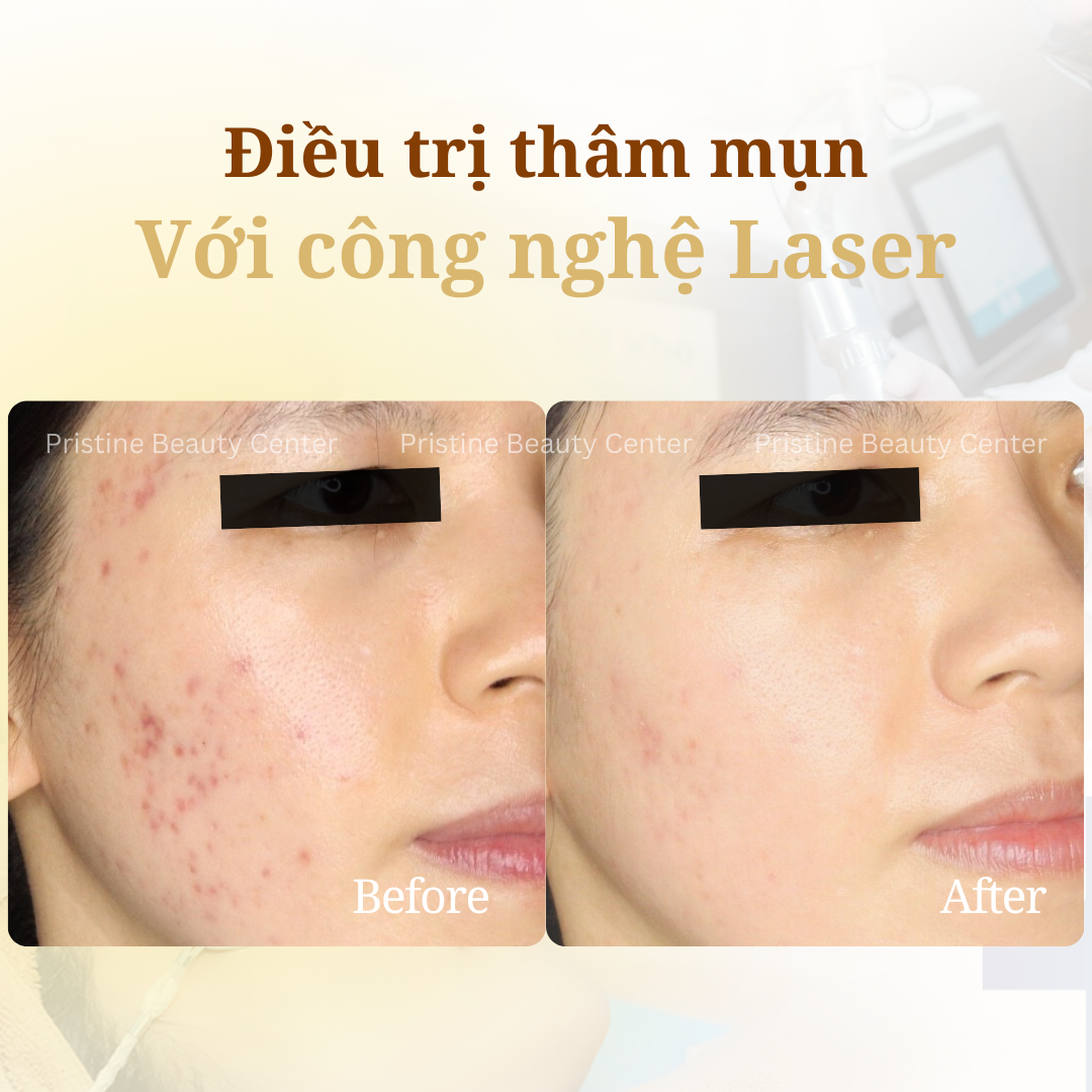 Điều trị Thâm