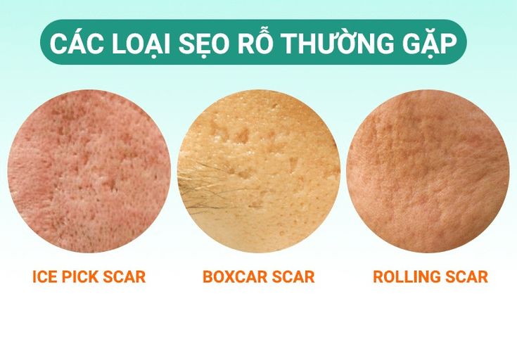 Điều trị Sẹo/rỗ