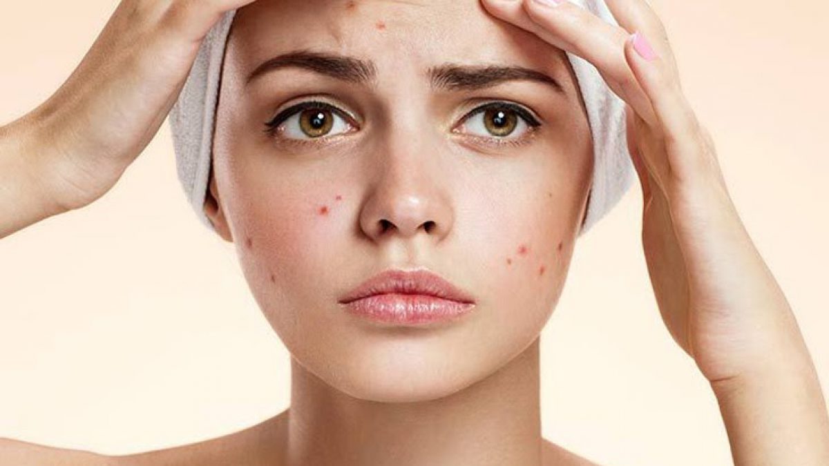 Điều trị Nám/tàn nhang