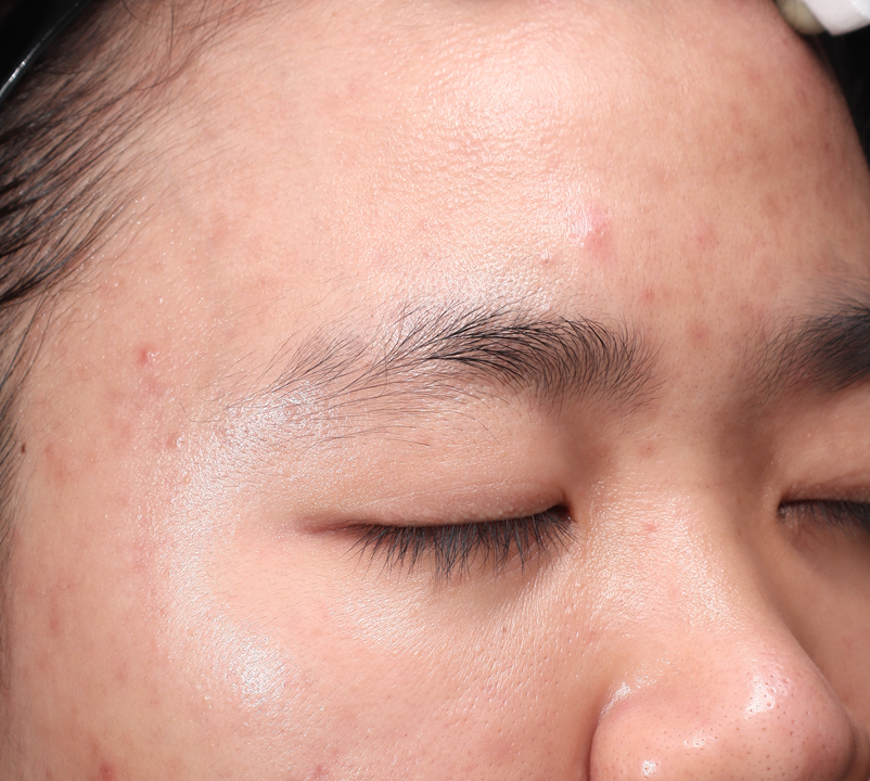 Hiệu quả điều trị