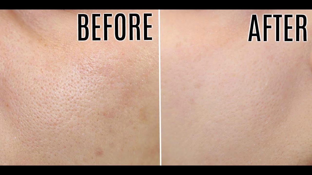 Sữa rửa mặt cho da dầu và da hỗn hợp Pharmaform Enzyme Cleanser Gel 150ml 5 Sữa rửa mặt cho da dầu và da hỗn hợp Pharmaform Enzyme Cleanser Gel 150ml