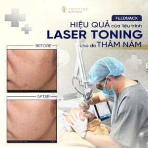 hiệu quả điều trị laser toning
