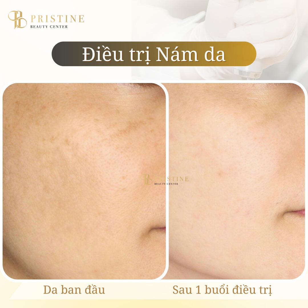 Giới thiệu 2 máy DISCOVERY PICO / SUPREMA 4 Giới thiệu 2 máy DISCOVERY PICO và SUPREMA
