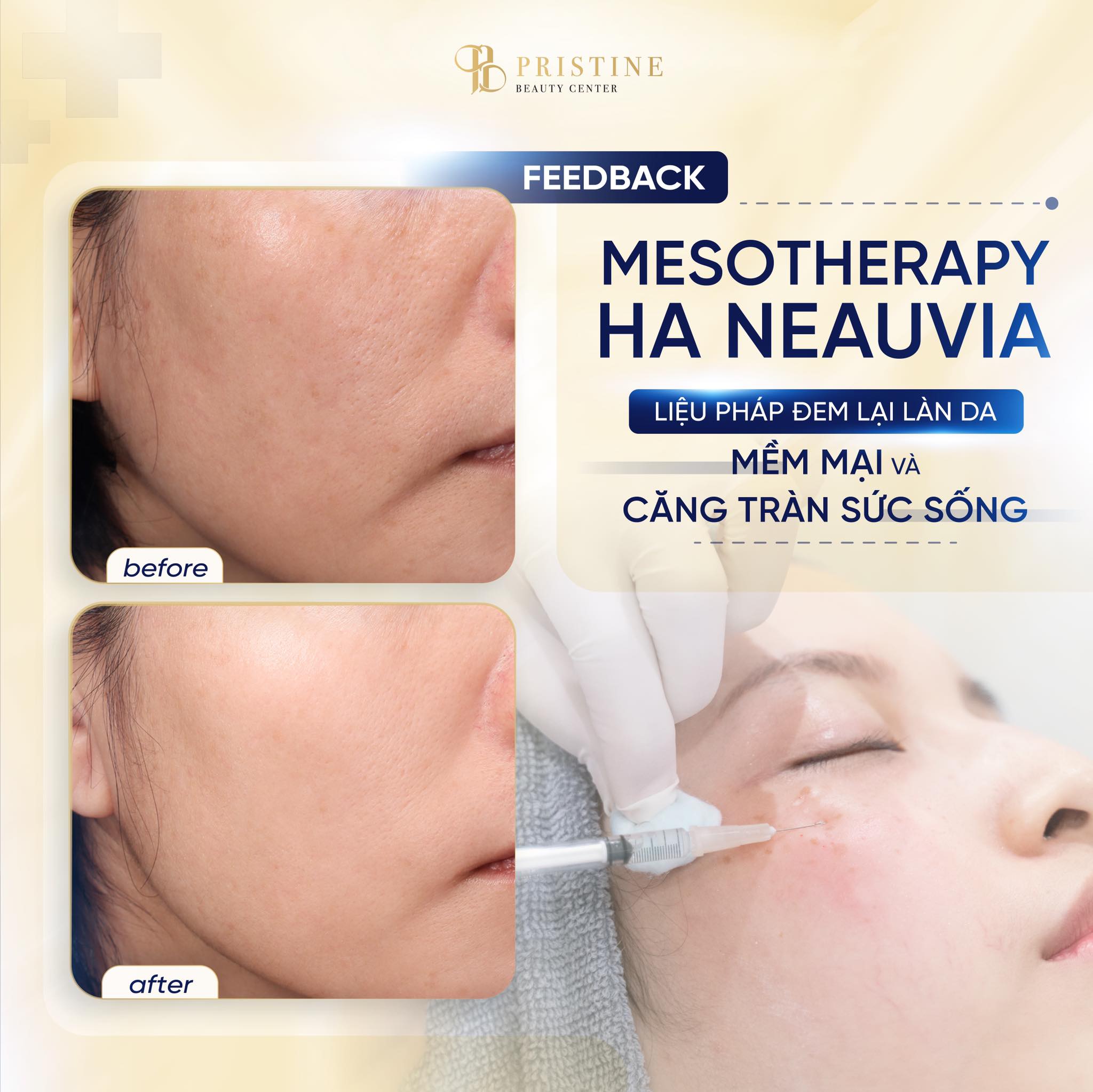 Mesotherapy HA Neauvia – Giải pháp da căng bóng tự nhiên 4 Mesotherapy-HA-Neauvia-4