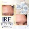 RF Bipolar Face - Trẻ hóa da, xóa nếp nhăn