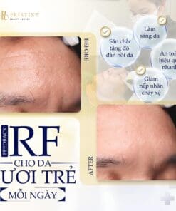 RF Bipolar Face - Trẻ hóa da, xóa nếp nhăn