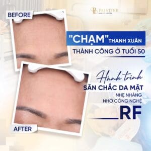 RF Bipolar Face - Trẻ hóa da, xóa nếp nhăn 1 những điều cần lưu ý sau điều trị RF