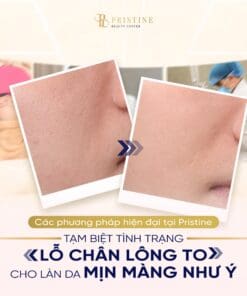 Laser Discovery Pico Carbon Face - Se nhỏ lỗ chân lông, làm mịn da
