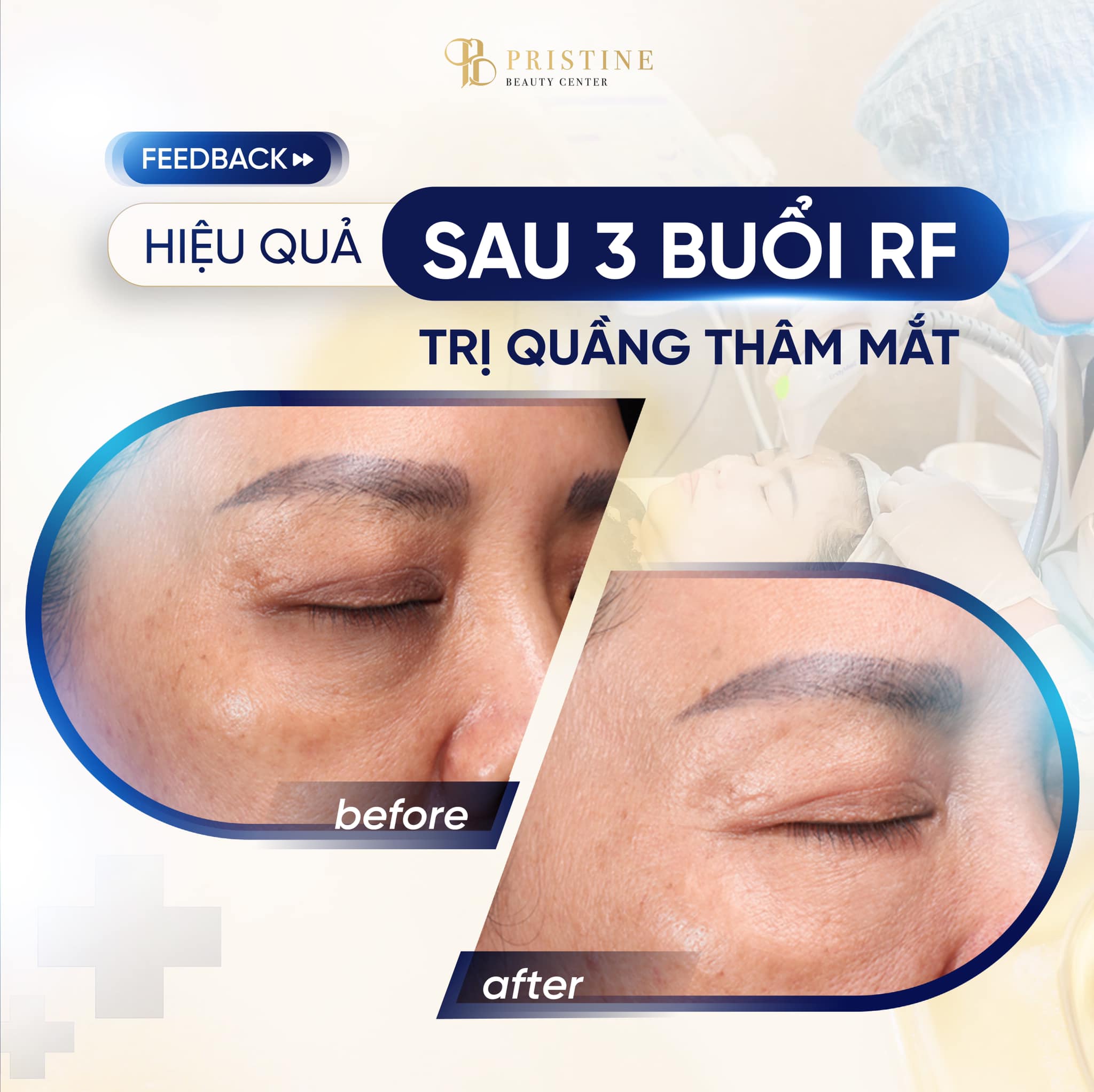 hieu-qua-dieu-tri-lao-hoa-da-vung-mat